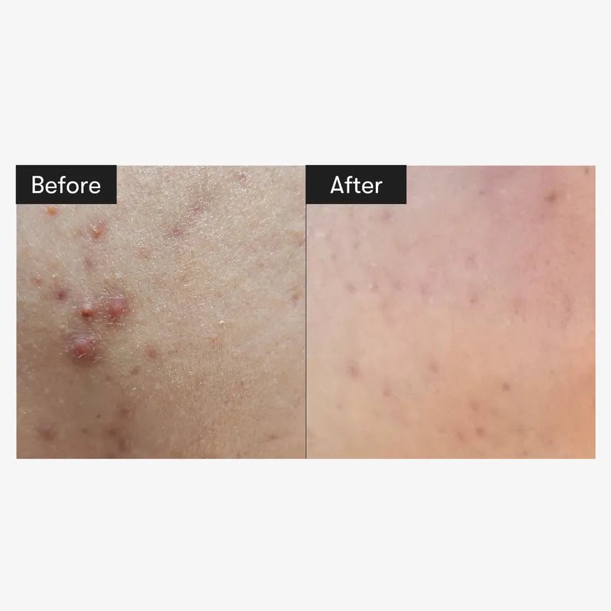 VT Cosmetic - Reedle Shot 300 Bosster