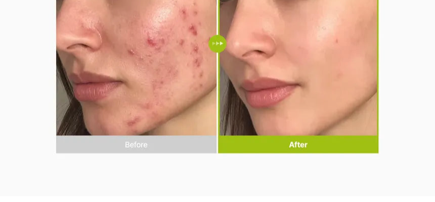 Purito SEOUL - Azelaic Acid 10 Kojic Tea Tree Serum